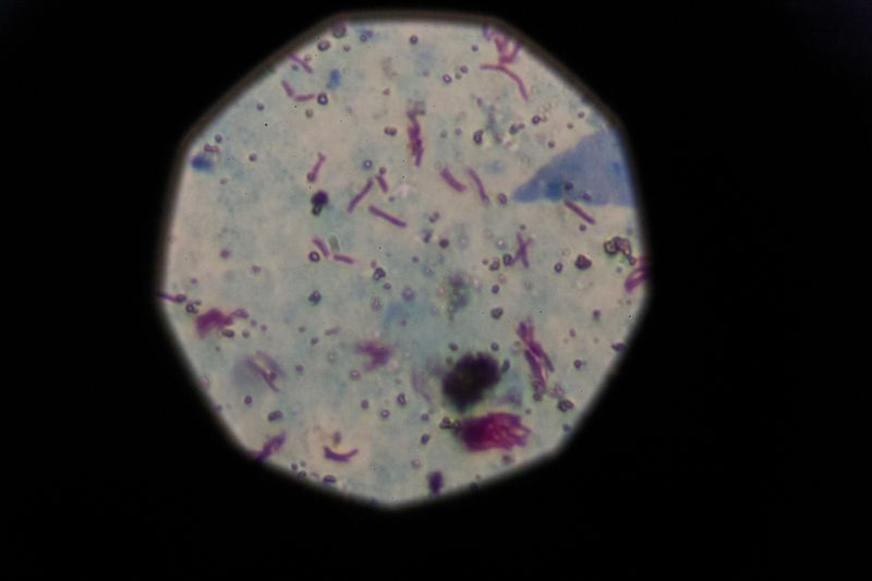 A sample that tested positive for tuberculosis is seen from a microscope in Buenos Aires, Argentina, March 29, 2019. Cases of the "white death" illness, closely linked to poverty, malnutrition and poor housing, have been on the rise since the turn of the decade as Latin America's third largest economy has grappled with repeat recessions and inflation. REUTERS/Magali Druscovich   SEARCH "ARGENTINA TB" FOR THIS STORY. SEARCH "WIDER IMAGE" FOR ALL STORIES.