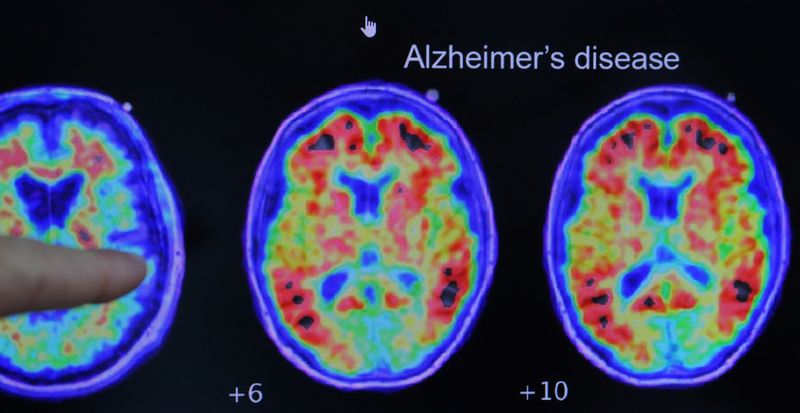 FILE PHOTO: Evidence of Alzheimer’s disease on PET scans. March 30, 2023. REUTERS/Brian Snyder/File Photo